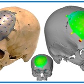 <span class=heading><b>Manufacturing new custom cranial implants</b> by Mohammad Salamati</span><br />Manufacturing tailored implants for patients is expensive and time consuming. Incremental Sheet Forming (ISF) is a fast and convenient way to shape titanium sheet to be used to repair head injuries and in reconstruction surgery. A collaboration between a local manufacturer (Pascoe Engineering Ltd), the AFRC and the Southern General Hospital has developed a manufacturing process to shape a flat titanium sheet accurately into a replacement cranial implant.<br /><span class=small>Image: © 2015 Mohammad Salamati</span>.  <span class=small>Collaborators: Pascoe Engineering, Southern General Hospital</span>